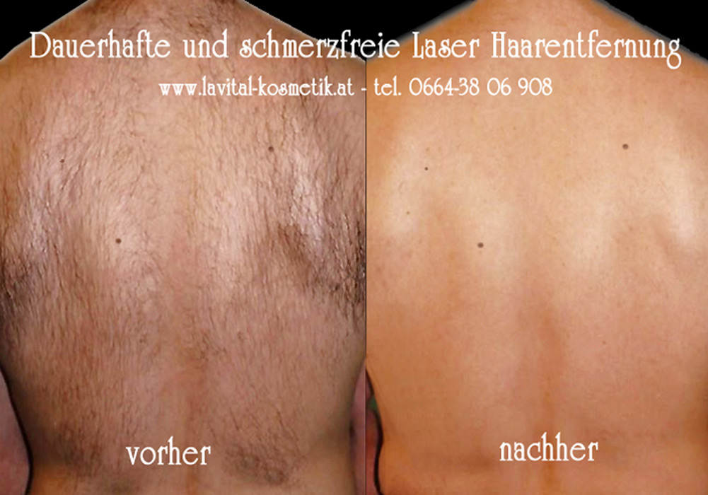 Laser Haarentfernung Klagenfurt Institut Schmerzfrei